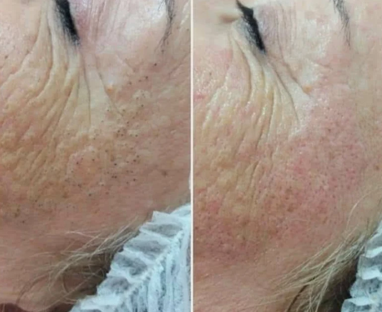 Limpeza de pele — antes e depois
